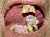Классификация и методы лечения плоскоклеточного рака полости рта