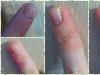 Мехлем за екзема на пръстите: преглед на ефективни лекарства Крем за екзема на ръцете